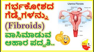ಗರ್ಭಕೋಶದ ಗೆಡ್ಡೆಗಳನ್ನು (Fibroids) ವಾಸಿಮಾಡುವ ಆಹಾರ ಪದ್ಧತಿ || Kannada Sanjeevani