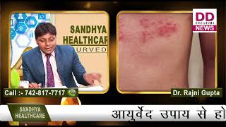 आयुर्वेद उपाय से होता हर्पीस ज़ोस्टर  का उपचार- Dr. Vikas Gupta || Divya Delhi