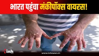 भारत में मिला Monkeypox का संदिग्ध मरीज, आइसोलेशन में रखा गया | Monkeypox in India