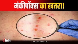 Bhopal News: Monkeypox Virus का खतरा! स्वास्थ्य विभाग ने जारी की गाइडलाइन | Monkeypox in India