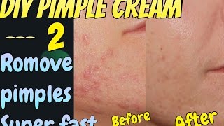 How to Remove Pimples FAST | Get Clear Whitening Skin | DIY Acne Treatment
