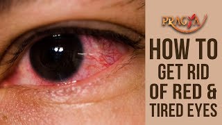 How To Get Rid Of Red & Tired Eyes | Payal Sinha