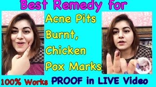 Best Home Remedy for Acne Pits, Burnt Marks, Chicken Pox Scars - Proof in LIVE Video | JSuper Kaur