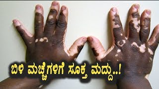 Best Treatment for White spots on the skin | Kannada Health Videos | Top Kannada TV