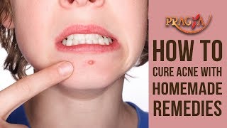 How To Cure Acne With Homemade Remedies | Payal Sinha