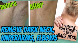 How to Lighten Dark Underarms & Dark Neck at Home | Home remedy to get Rid of Dark underarms & Neck