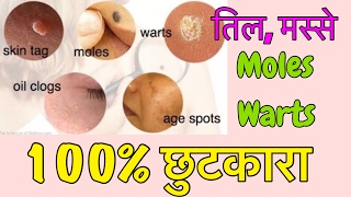 Natural Remedy to Remove Moles, Warts, Pimples, Acne, Age Spots | 100% EFFECTIVE | JSuper Kaur