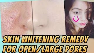 DIY NATURAL Skin Whitening Cubes for Open Pores | How to get rid of Open/Large pores | JSuper Kaur